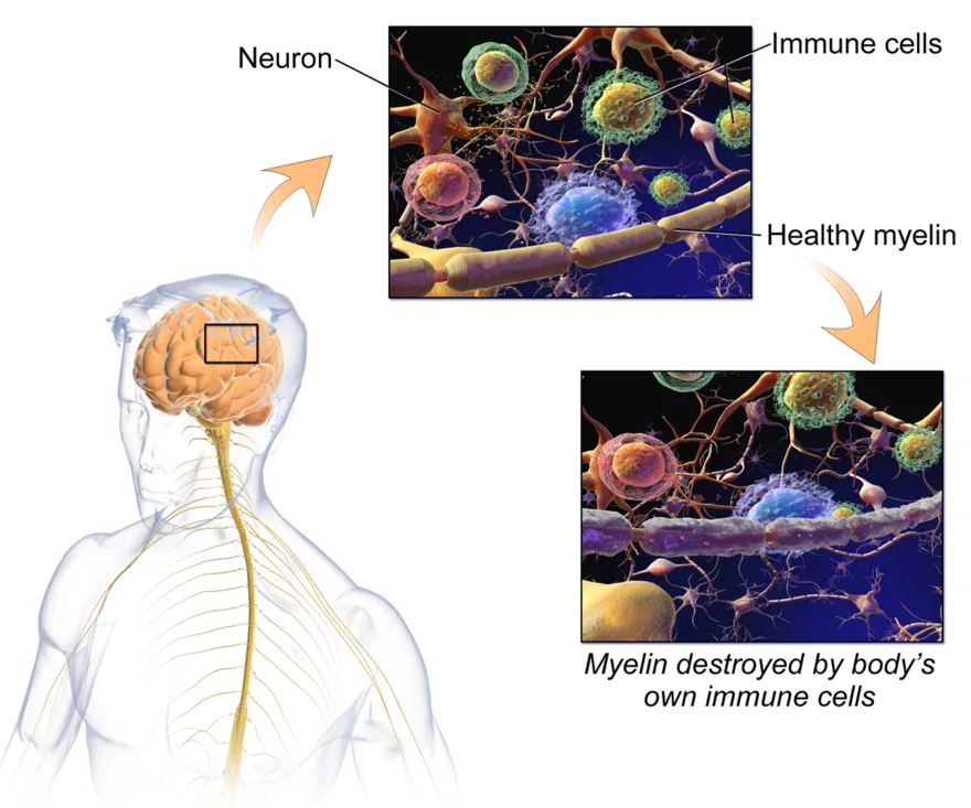 Multiple sclerosis: damaged myelin sheaths on nerve fibers