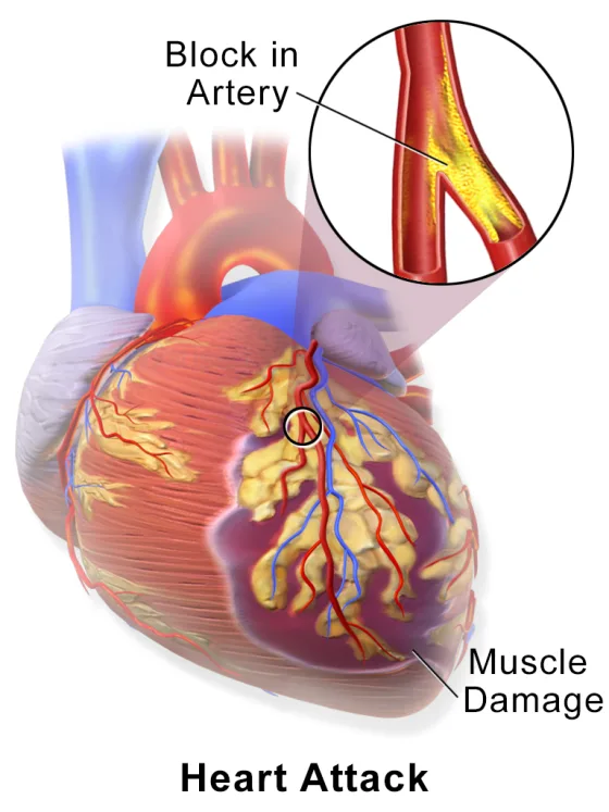 Heart attack: a blocked coronary artery causing heart-muscle damage