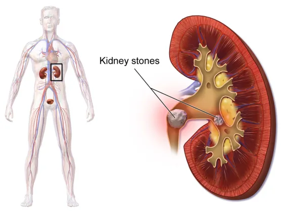 Kidney stones lodged in the kidney and ureter