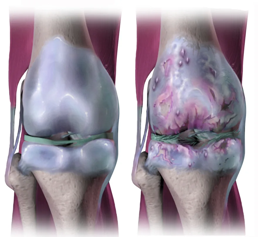 Osteoarthritis: worn cartilage in a joint