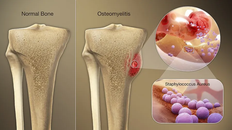 Osteomyelitis — clinical diagram