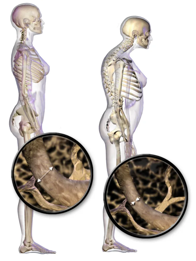 Osteoporosis: normal versus porous, thinned bone