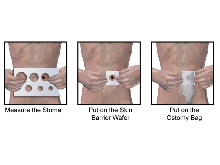 Ostomy Care — medical illustration
