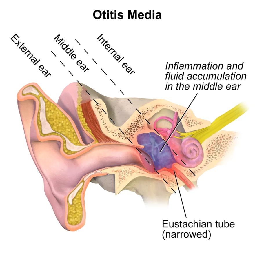 Otitis media: fluid and inflammation in the middle ear