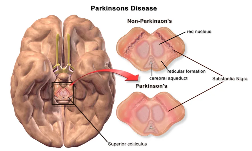 Parkinson disease: loss of dopamine-producing neurons
