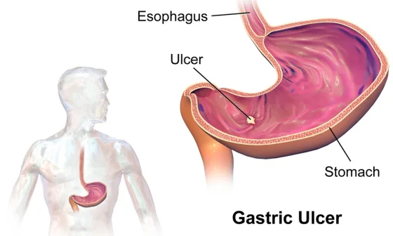 Gastric ulcer eroding the stomach lining