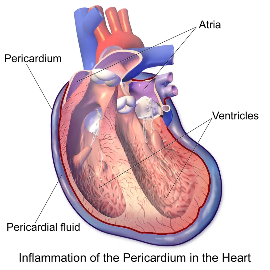 Pericarditis: inflammation of the sac around the heart