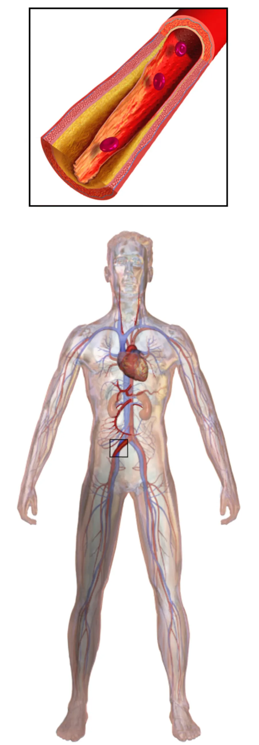 Peripheral Arterial Disease — medical illustration