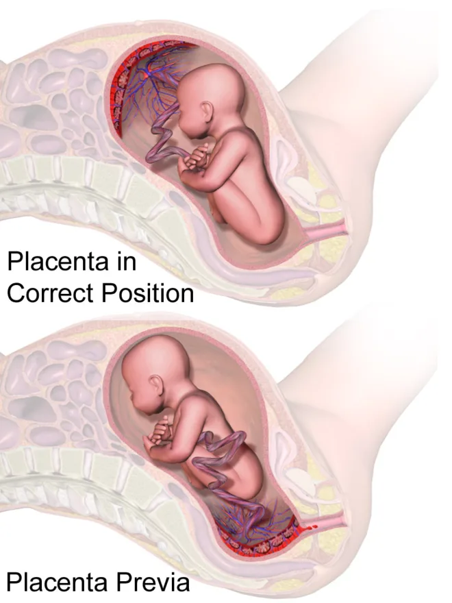 Placenta previa: the placenta covering the cervical opening