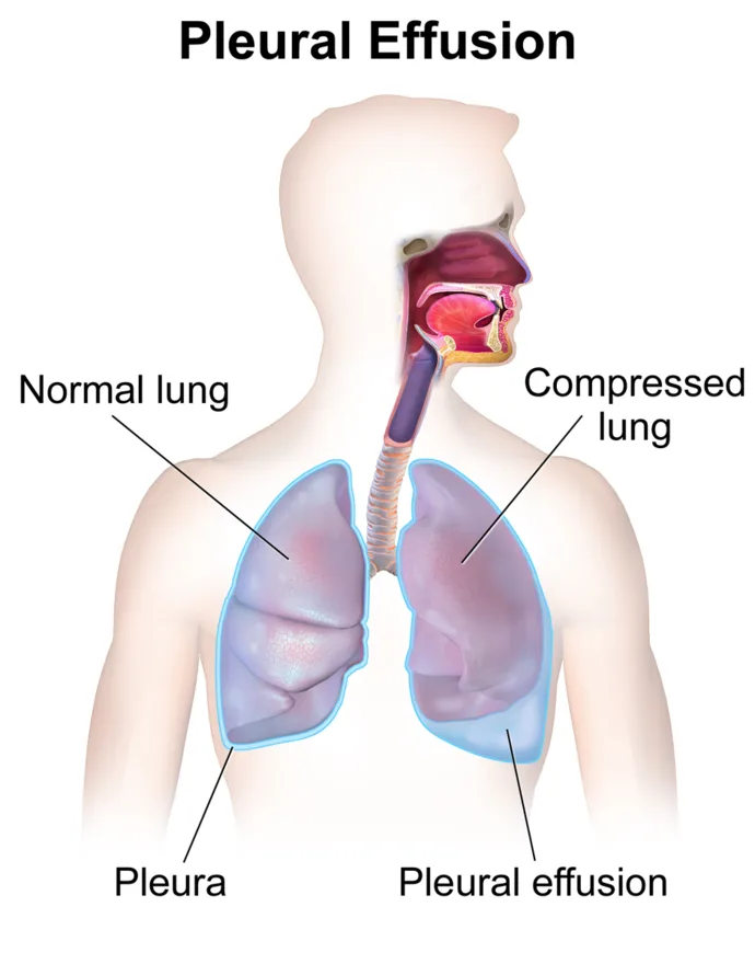 Pleural effusion: fluid in the pleural space compressing the lung