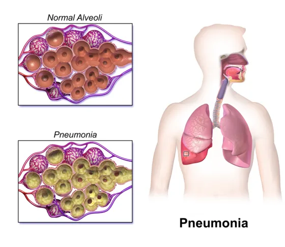 Pneumonia: fluid-filled versus normal alveoli