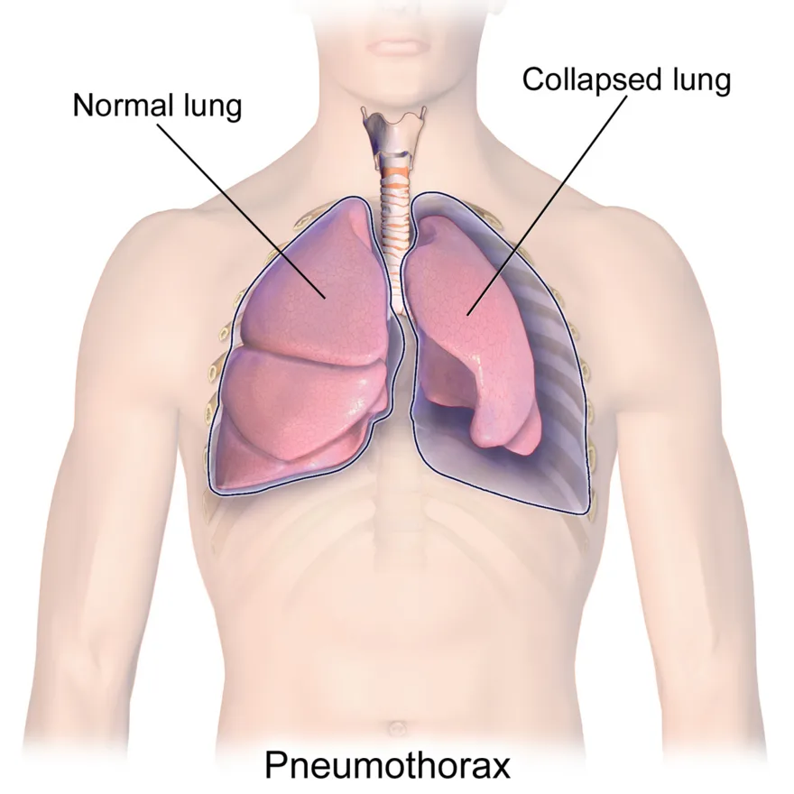 Pneumothorax: air in the pleural space collapsing the lung
