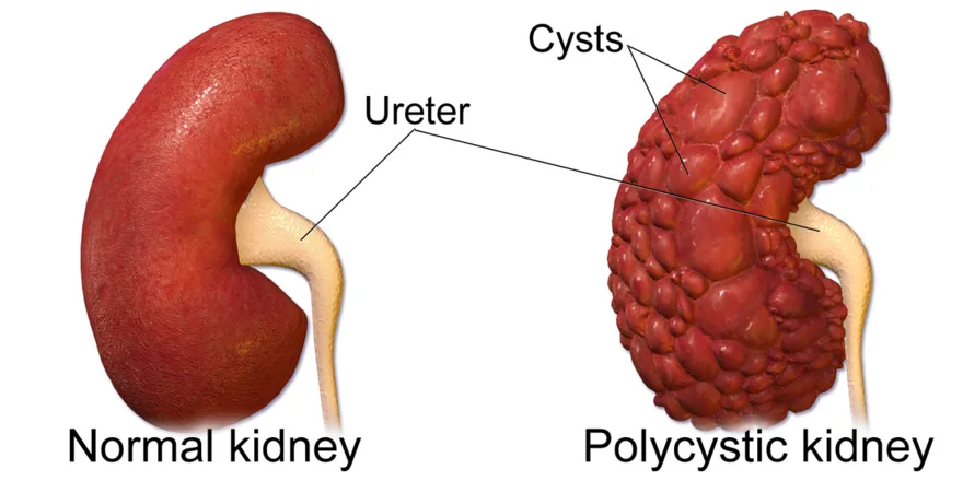 Polycystic kidney disease: a normal kidney versus one full of cysts