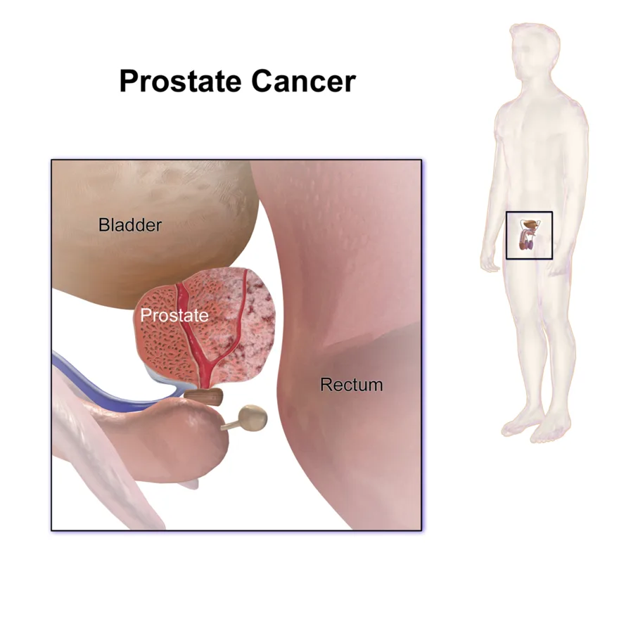 Prostate cancer in the prostate gland