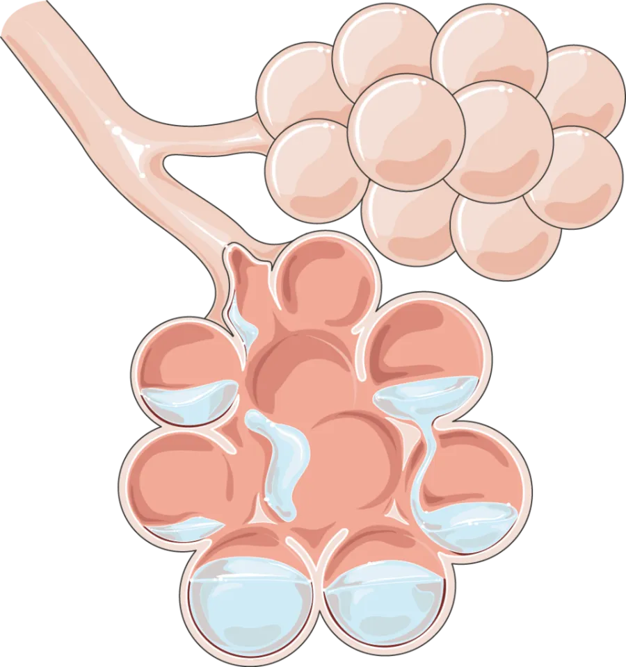 Pulmonary Edema — medical illustration