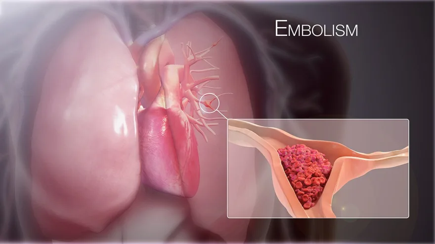 Pulmonary embolism: a clot lodged in a pulmonary artery