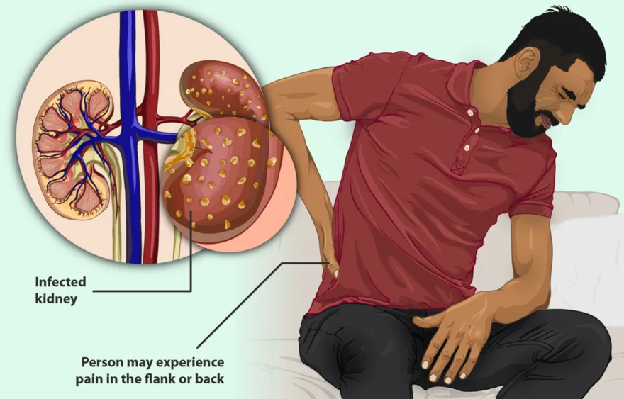 Pyelonephritis: infection involving the kidney