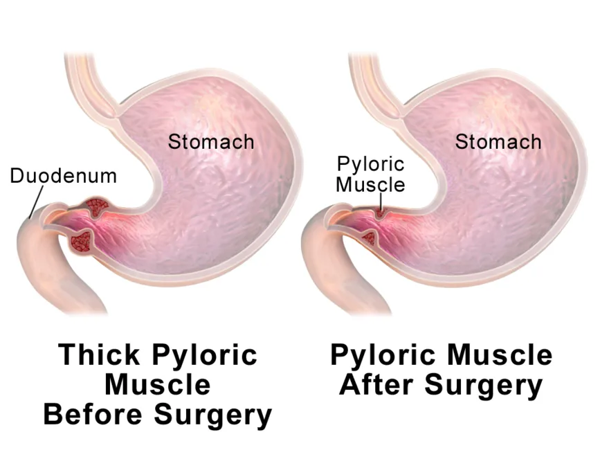 Pyloric stenosis: a thickened pyloric muscle before and after surgery