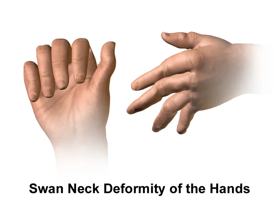 Rheumatoid arthritis: an inflamed, swollen joint
