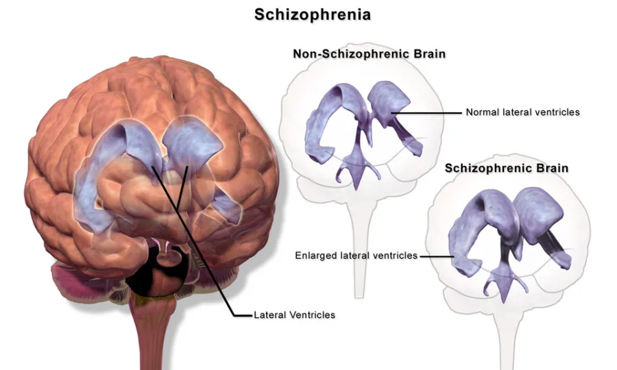 Schizophrenia — medical illustration