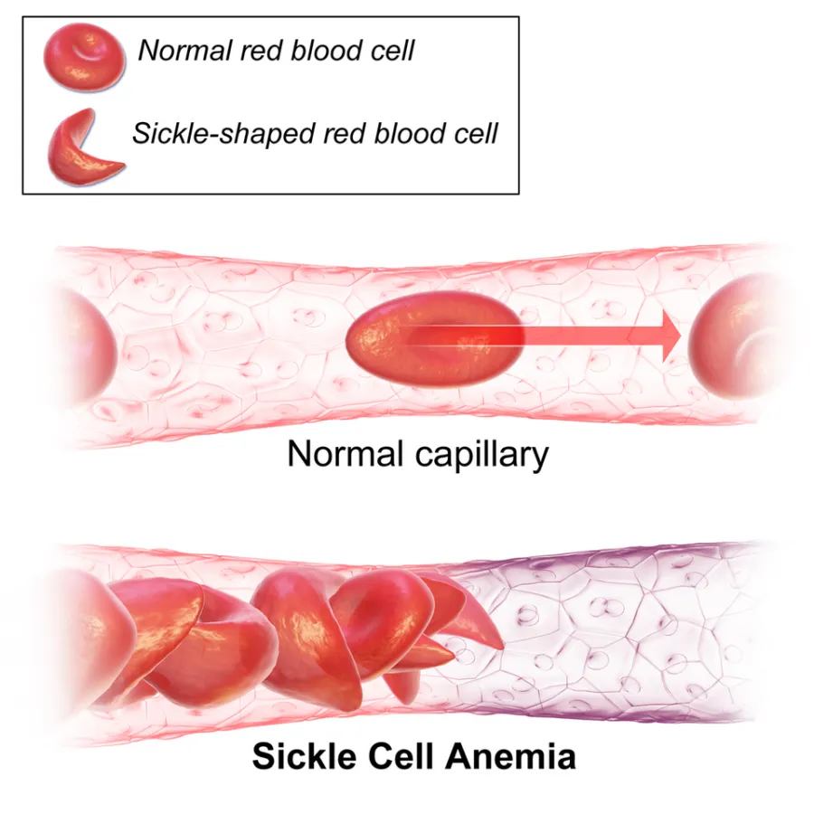 Sickle Cell Crisis — medical illustration