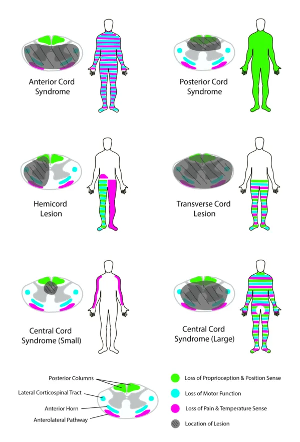 Spinal cord injury: sensory and motor loss by cord syndrome