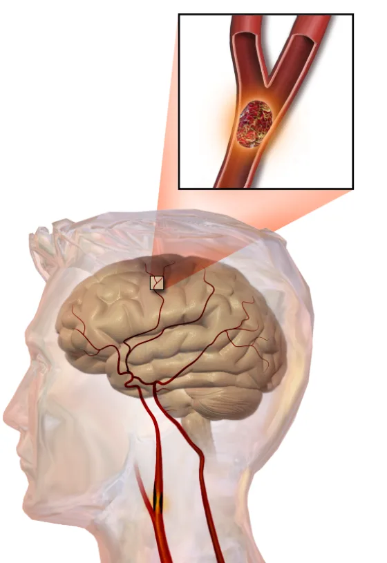 Ischemic stroke: a clot blocking a cerebral artery
