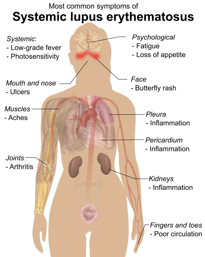 Systemic lupus erythematosus: common multi-system symptoms