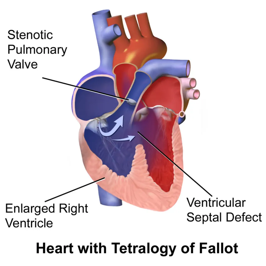Tetralogy of Fallot — medical illustration