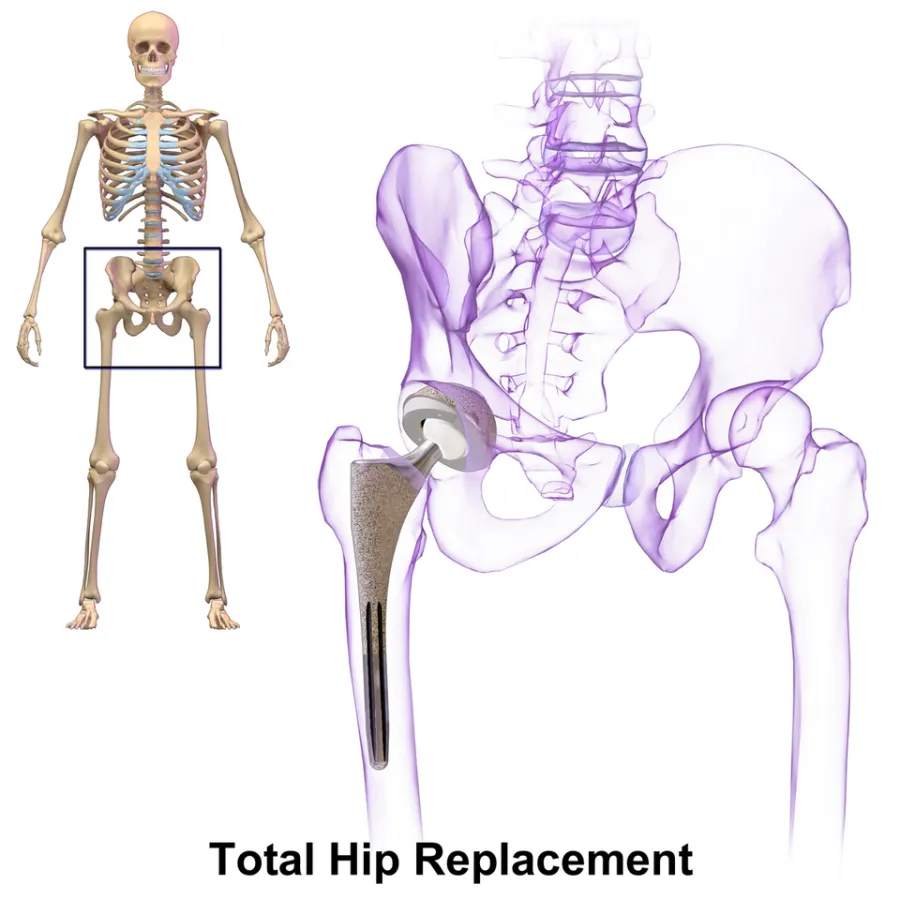 Total Hip Replacement — medical illustration