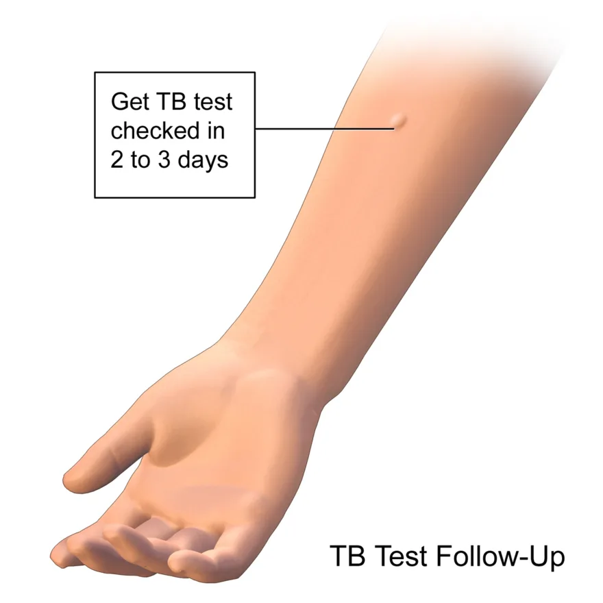 Tuberculosis infection in the lungs