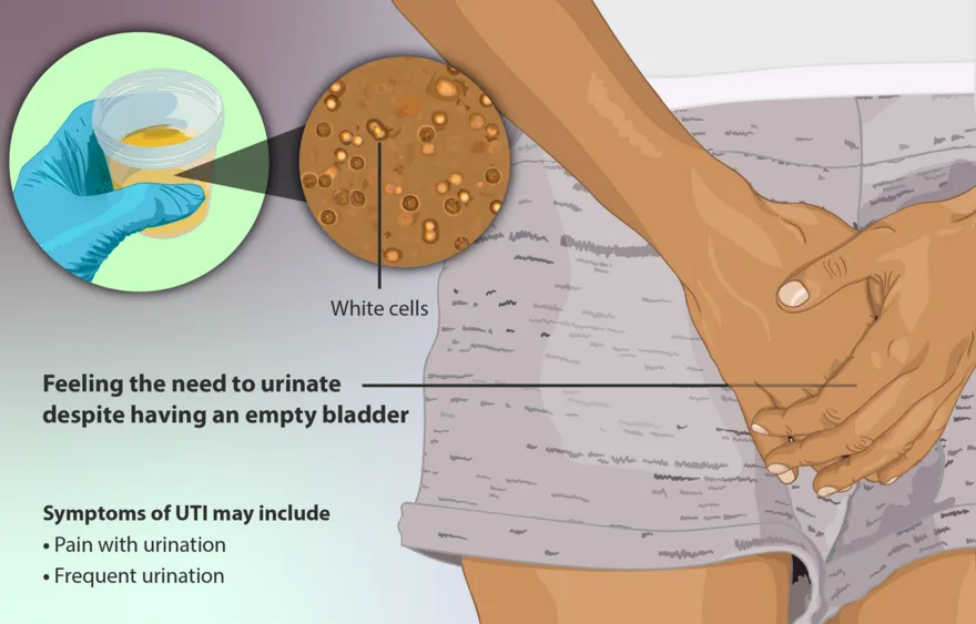 Urinary tract infection of the bladder and urethra