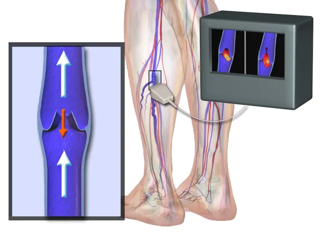 Varicose veins: incompetent valves causing dilated, twisted veins
